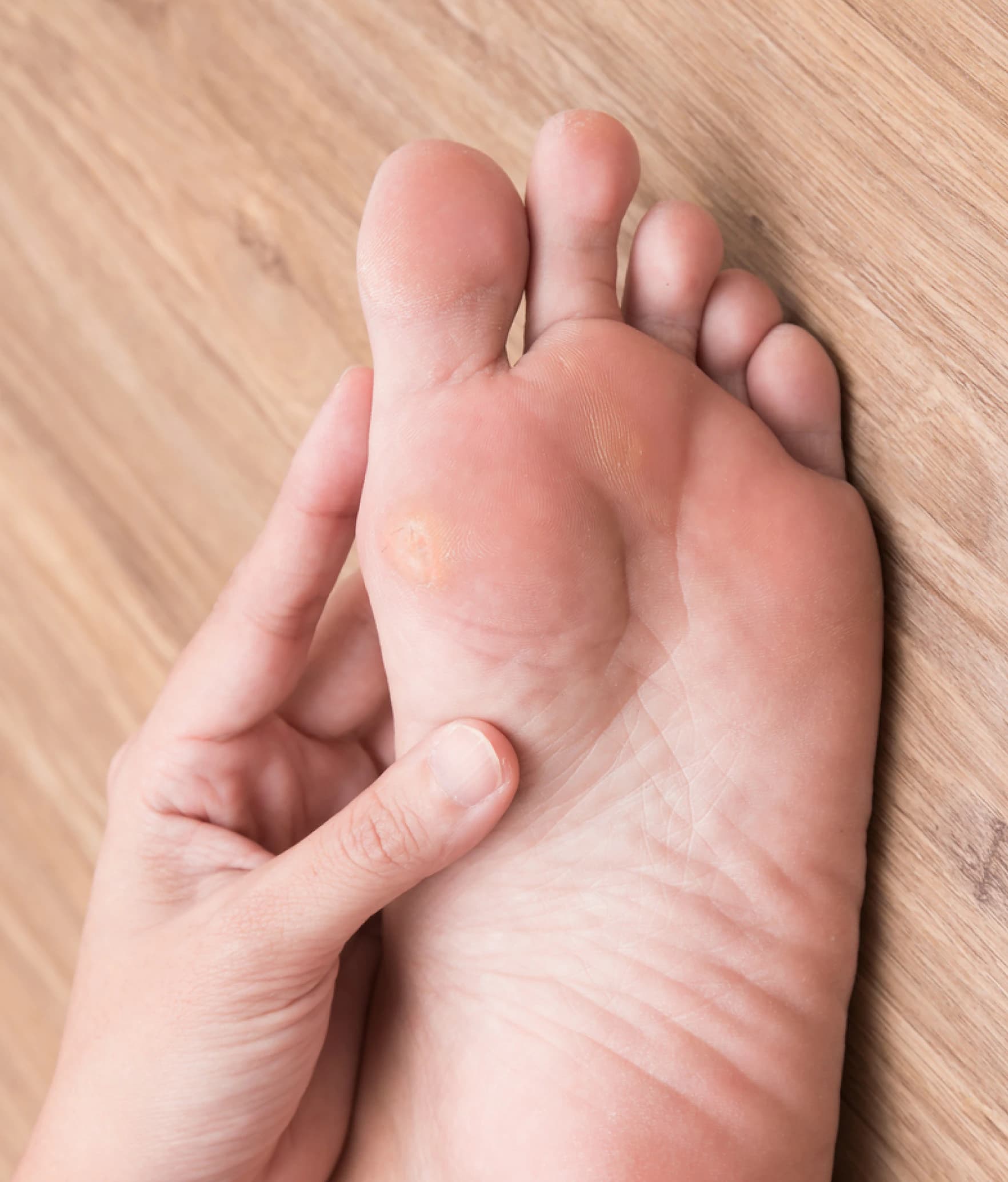 Thickened, callused skin on the sole of the foot