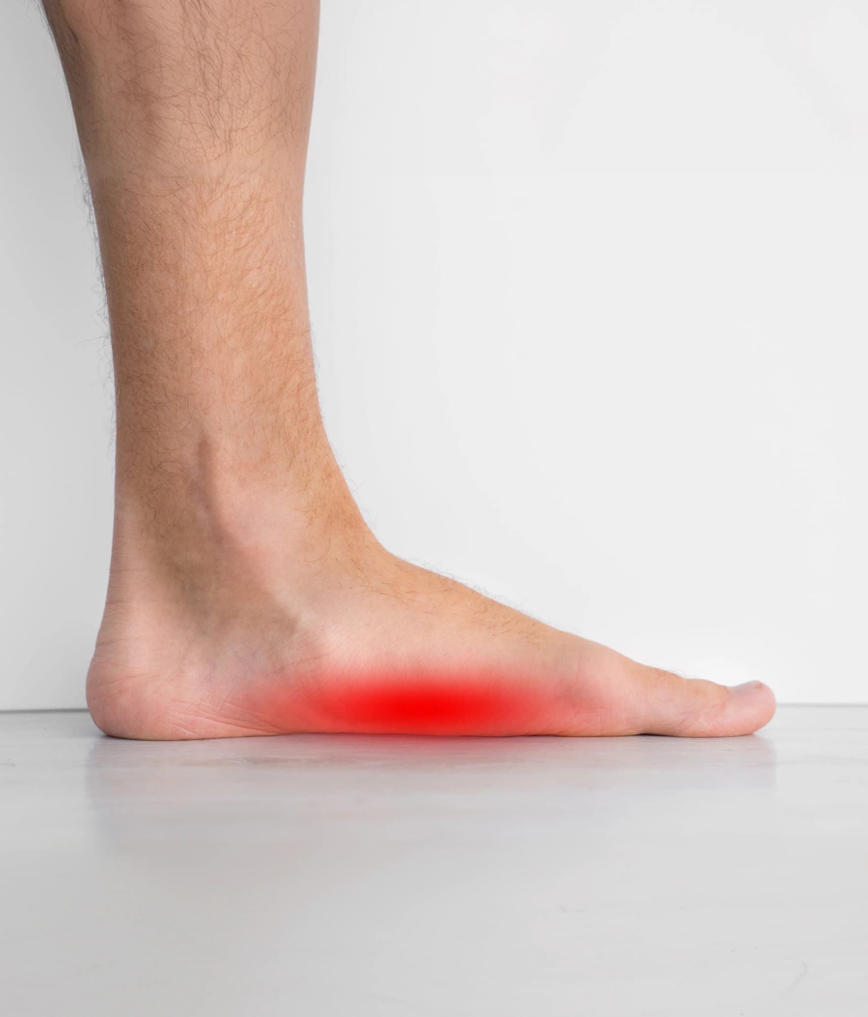 A foot with a low, flattened arch, with the arch highlighted