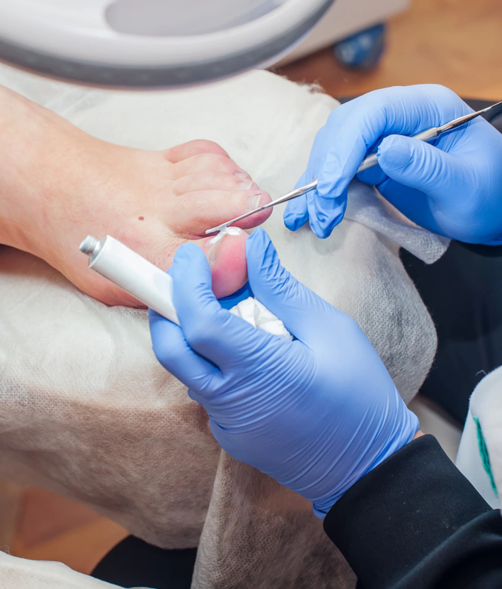 A fungal toenail being treated in a clinical setting