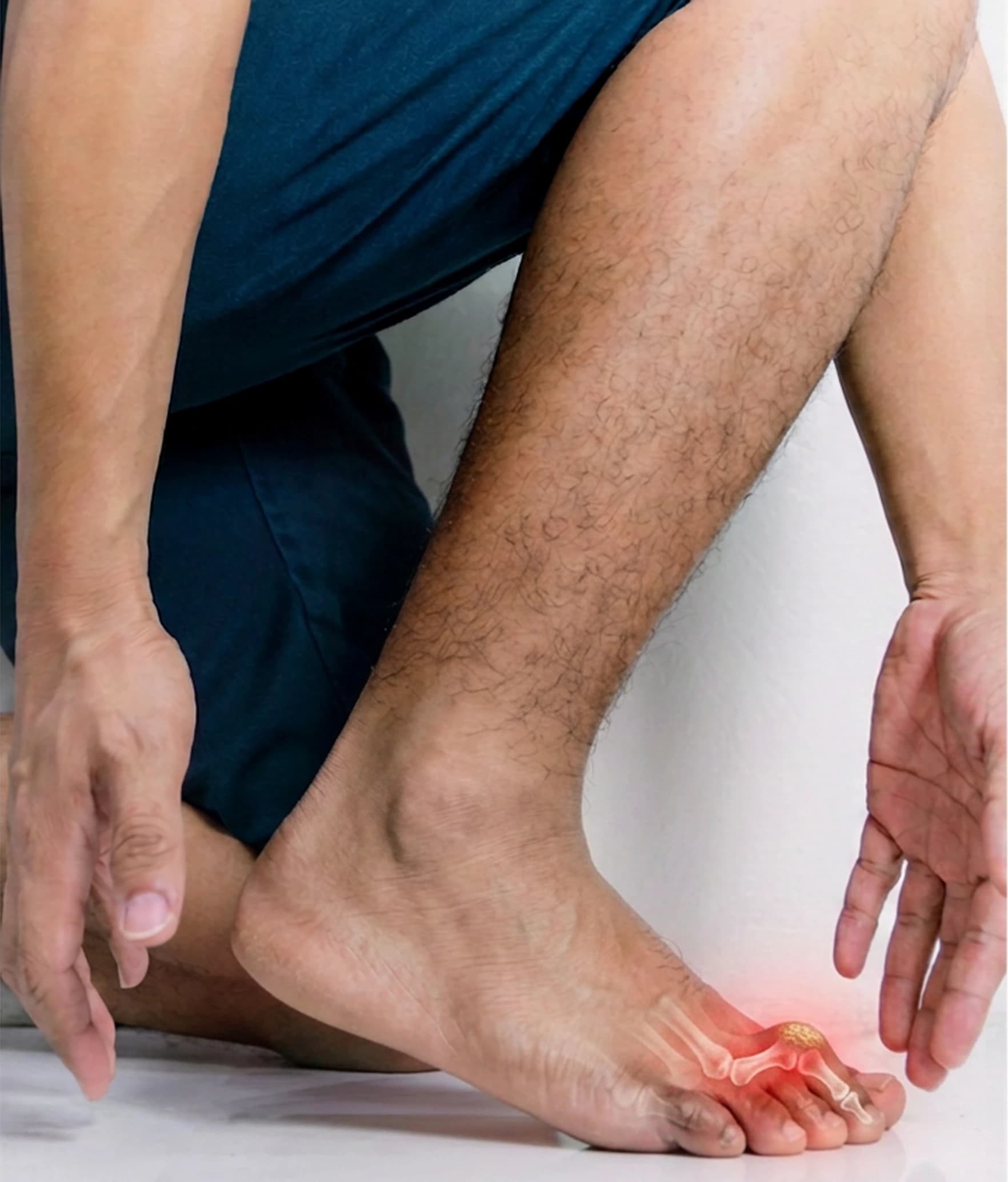 Toes bent into a hammer-toe position, with the affected joints highlighted
