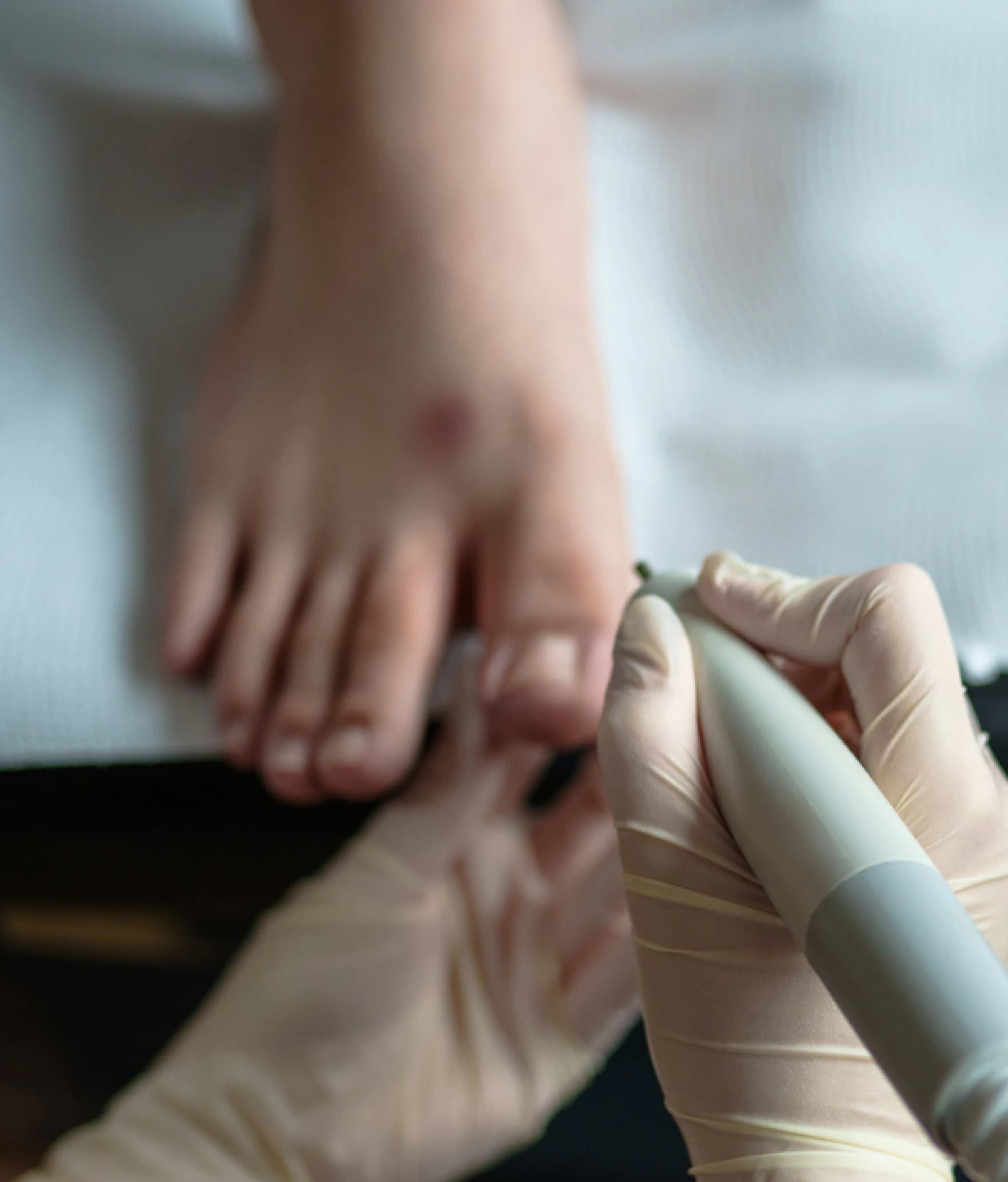A painful ingrown toenail on the big toe being treated