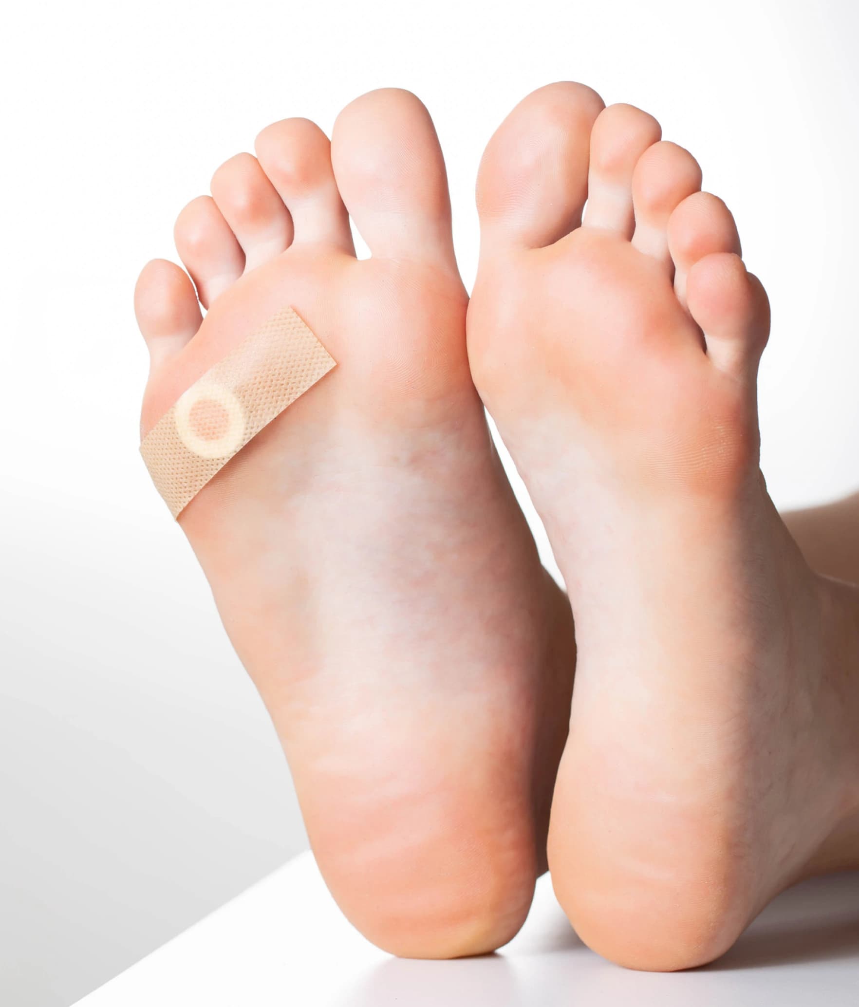 A plantar wart on the sole of the foot